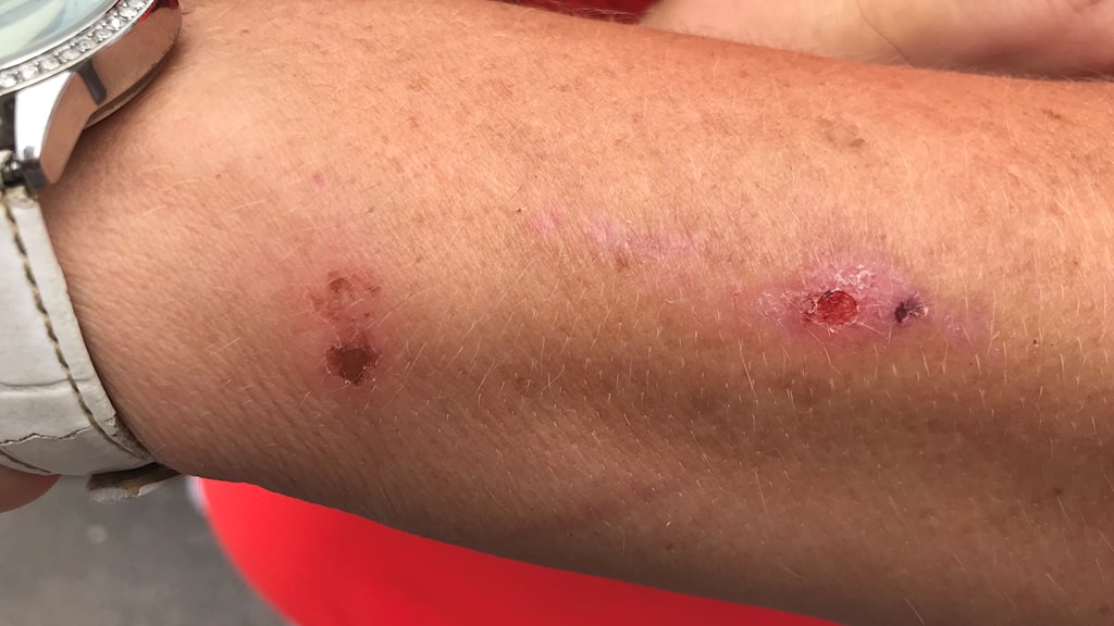 lär dig allt om hur gidlöf sjukhus behandlar myggbett och vilka råd de ger för att lindra klåda och förebygga infektioner. effektiva tips och medicinska rekommendationer.